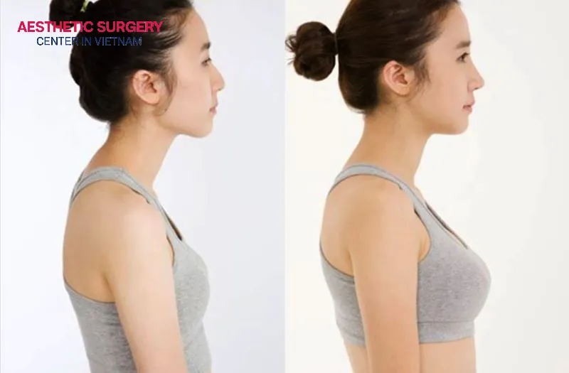 You can either use your own body fat without artificial materials or choose to have artificial breast implants placed.