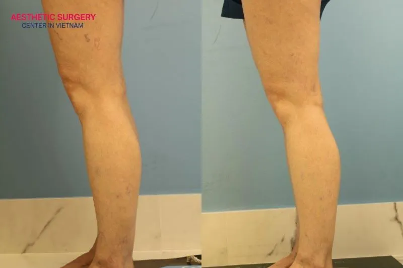Patient’s calf contours after undergoing calf lipoplasty at Aesthetic Surgery Center.