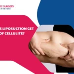 does Liposuction get rid of cellulite