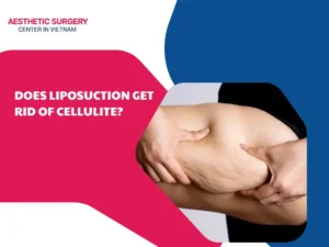 does Liposuction get rid of cellulite