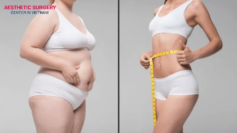 Can remove excess fat in the hips and thighs to create attractive curves