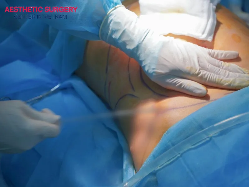 It is possible to remove about 4–5 liters of fat in a single Liposuction session.