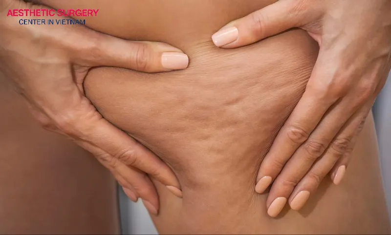 Liposuction does not completely remove cellulite.