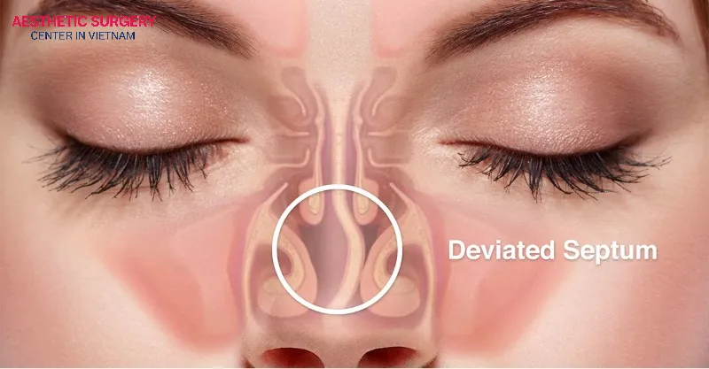 Septoplasty corrects a deviated nasal septum.