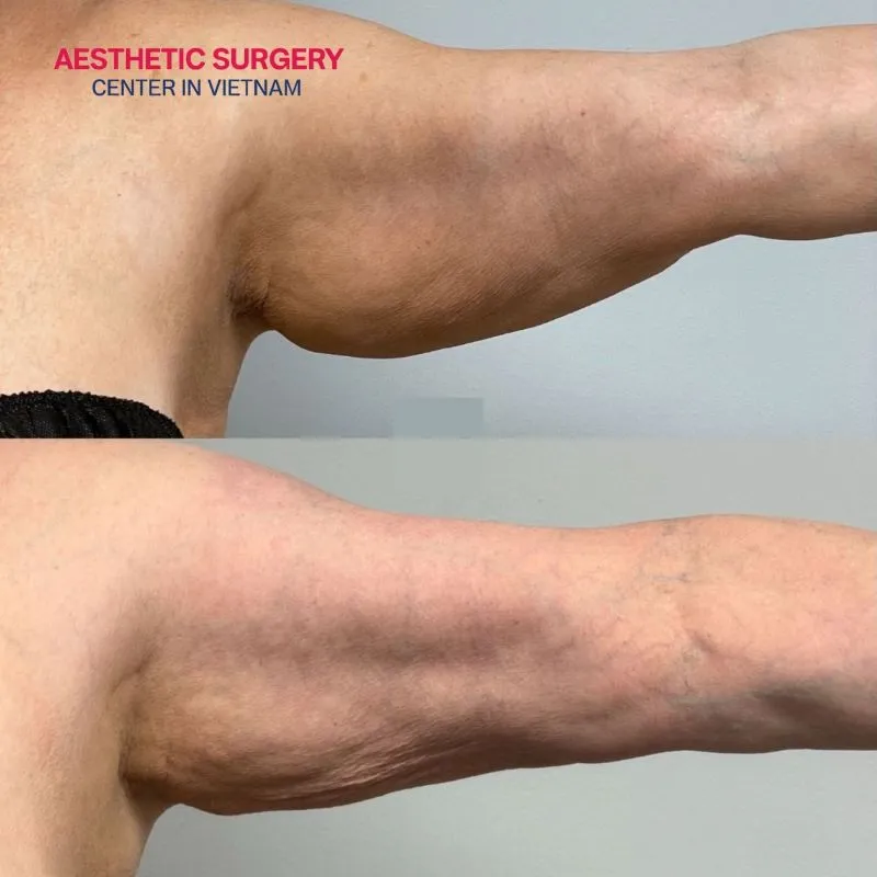 The skin becomes hard and uneven if the healing process is uneven.