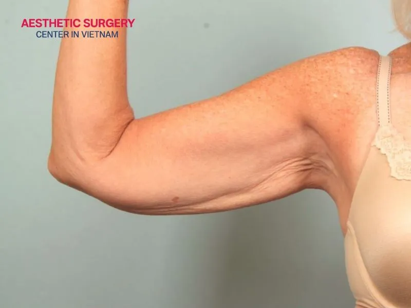 After liposuction, fibrosis may cause mild tenderness when touched.