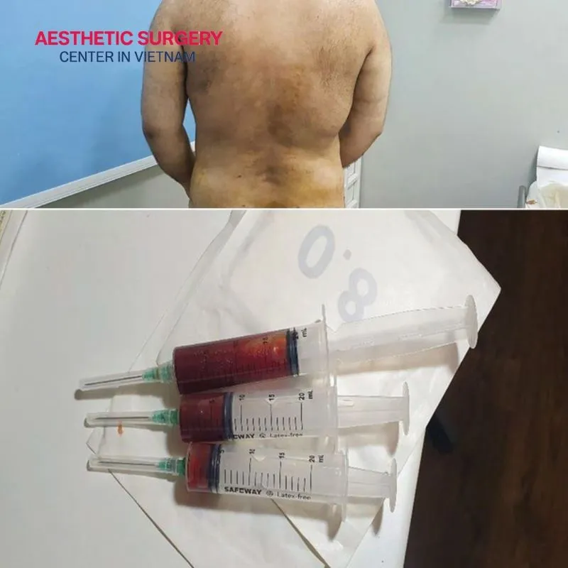 After removing a large amount of fat, tissue fluid can accumulate under the skin if the body cannot drain it quickly enough.