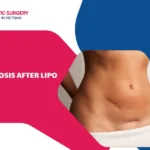 fibrosis afterlipo