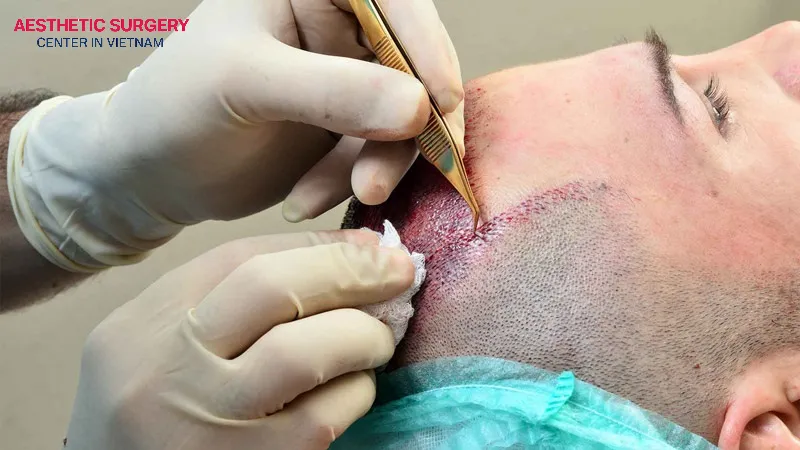 Hair transplantation is a modern cosmetic method that restores naturally thick and healthy hair.