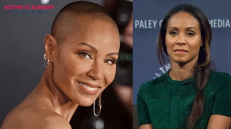 Actress Jada Pinkett Smith’s hair transplant journey has become an inspiring example for women facing similar hair loss challenges.