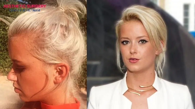 Olivia Bentley, star of Made in Chelsea, also chose hair transplantation to improve her hair.