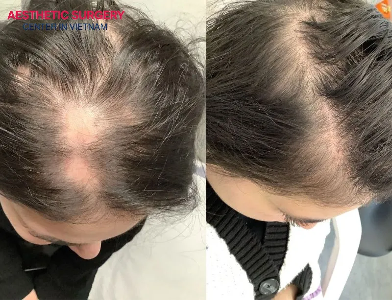 After the procedure, a small number of patients may experience hair transplant side effects such as follicle damage.