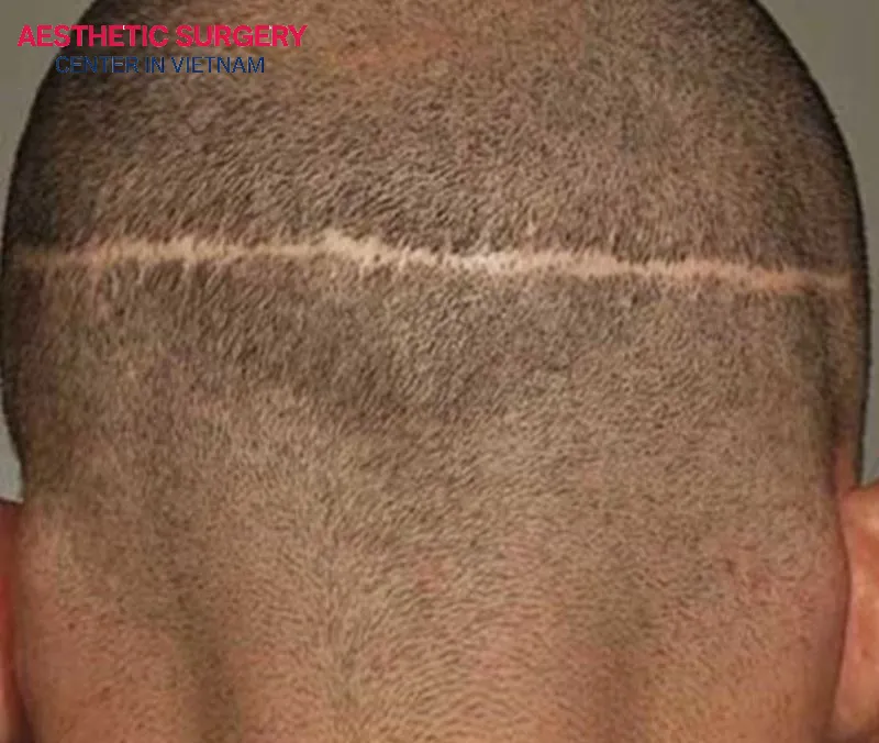 For patients undergoing the FUT hair transplant method, a thin linear scar may remain on the back of the head.
