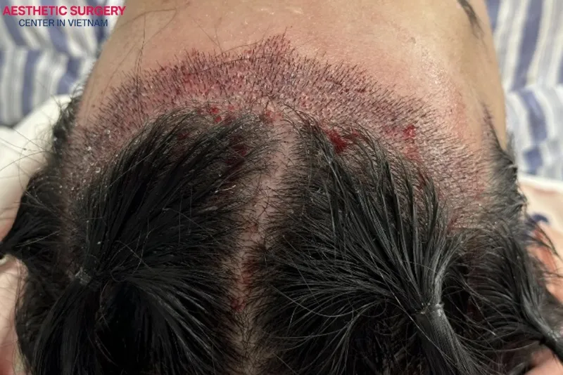 Using the FUE technique creates tiny dot-like marks on the scalp, which are usually well covered by surrounding hair.