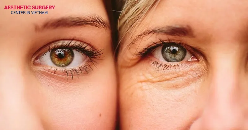 Skin aging is the main cause of hidden eyelid creases.