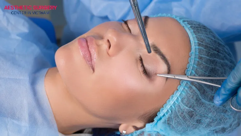 Eyelid stitching is a non-surgical eyelid crease creation technique.