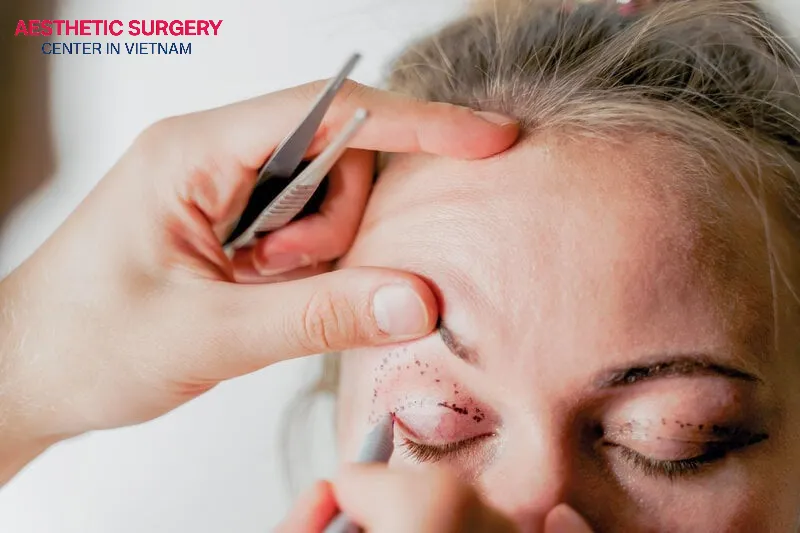 Eyelid surgery is a solution that delivers effective and long-lasting results.