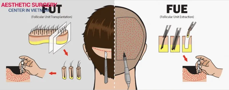 FUT and FUE – two popular hair transplant methods today