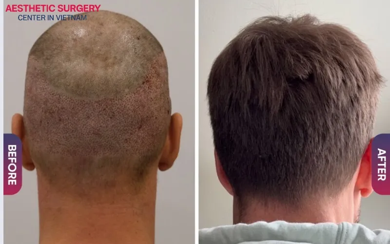 Hair transplant delivers healthier, thicker, and more natural-looking hair.
