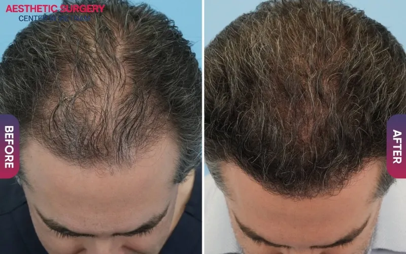 Restore thinning hair with hair transplant.