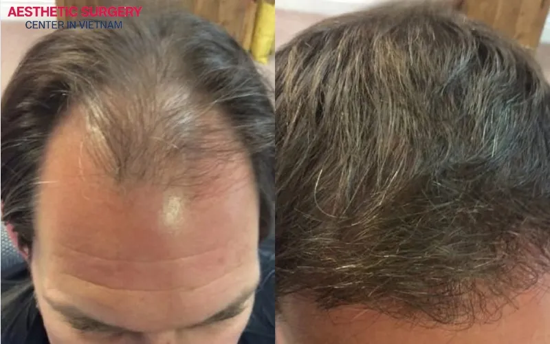 Hair transplant helps address baldness on the sides of the head.