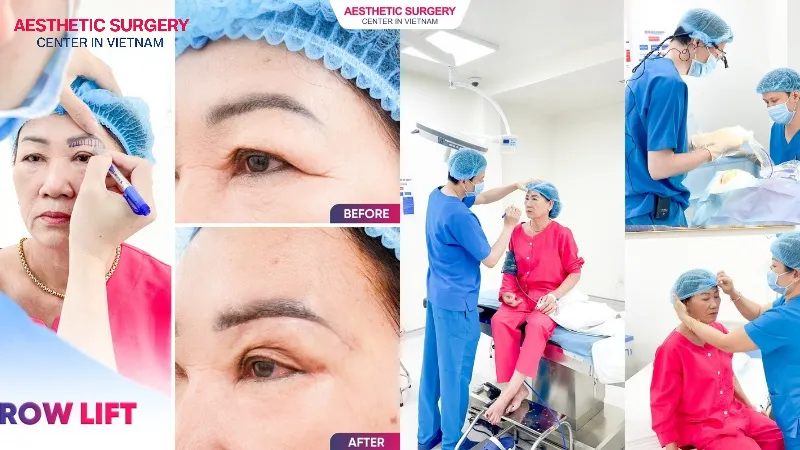 Brow Lift at Aesthetic Surgery In Vietnam
