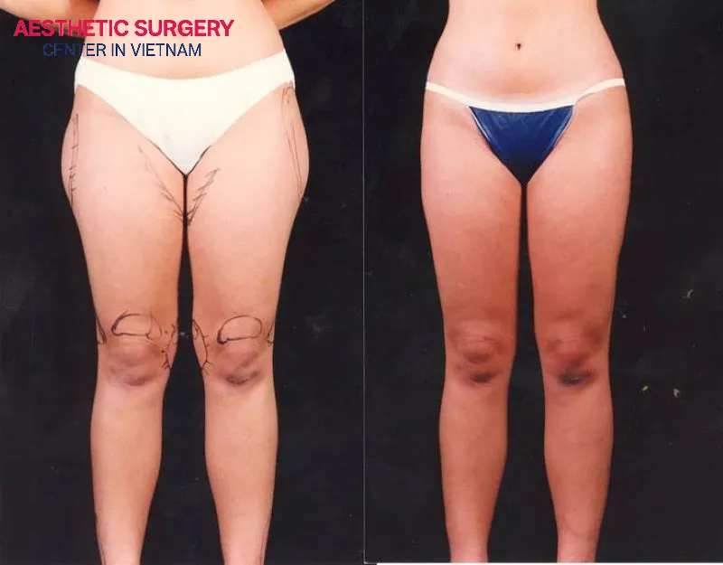 Knee liposuction helps make the legs look slimmer and more toned.