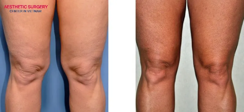 After recovery, the skin also stabilizes its collagen structure, helping the legs maintain firmness and smoothness over time.