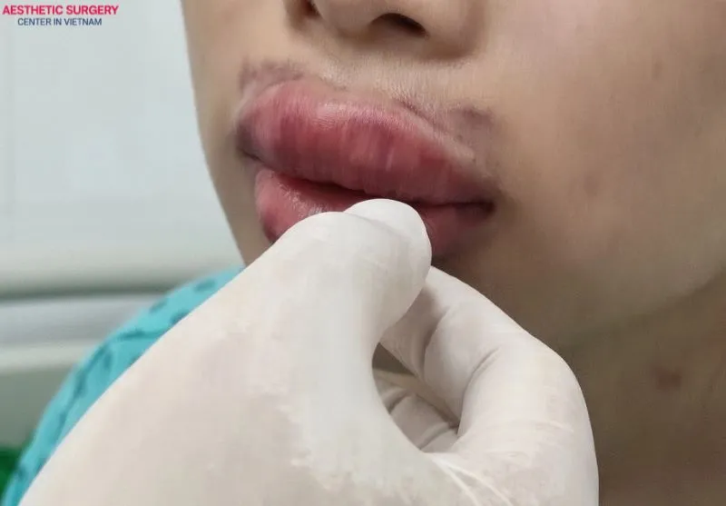 About 2–3 days after lip filler injections, swelling may start to go down, but bruising often appears.
