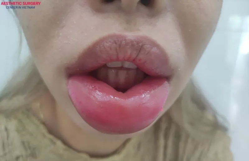 Lip swelling after filler injections is a normal body reaction and usually subsides within a few days. However, if swelling persists, you should visit a medical facility for proper evaluation and care.