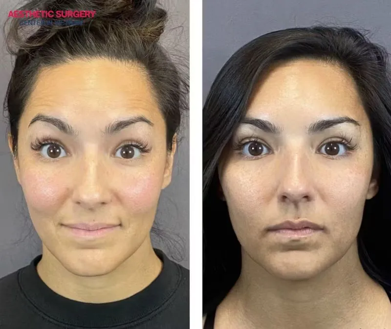 Before-and-after images of client’s faces following Botox and filler treatments.