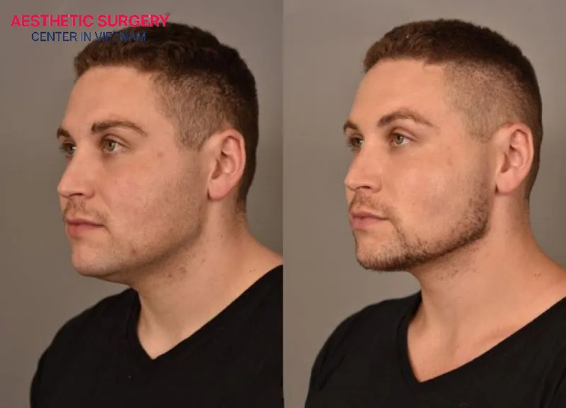 Images showing the patient’s neck area before and after the neck liposuction procedure.