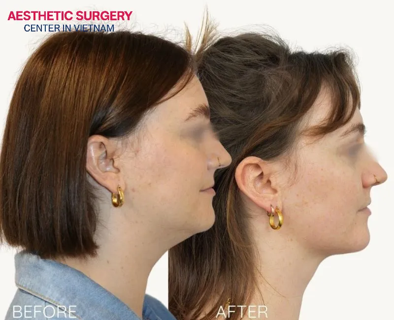 Patients with lighter skin tones often see more visible results after the procedure.