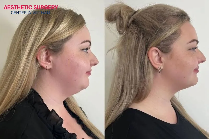 This procedure helps enhance the jawline and highlight the natural contours of the face.
