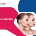 Neck liposuction: Ideal solution for neck fat removal