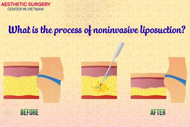 The noninvasive liposuction process is typically quick, simple, and safe.