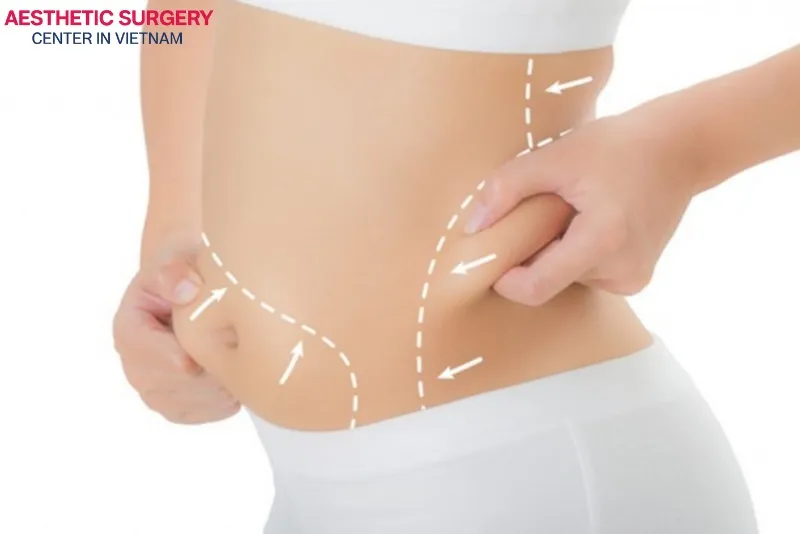 Noninvasive liposuction helps restore a slimmer, more contoured figure as desired.