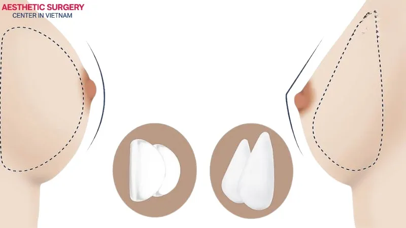 Image comparing the shape of teardrop breasts and round breasts
