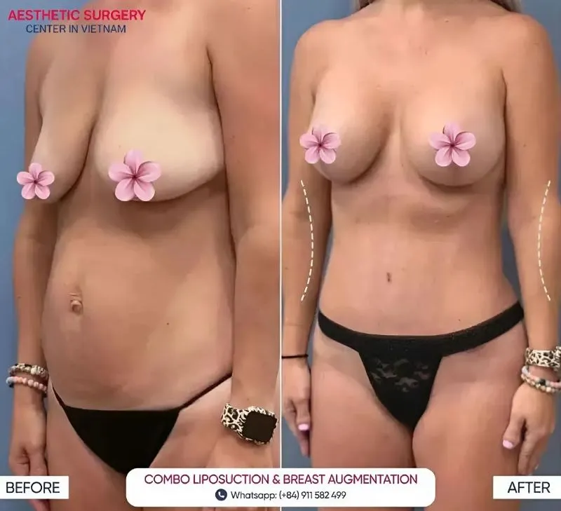 Patient results after undergoing tubular breast augmentation at Aesthetic Surgery Center in Vietnam.