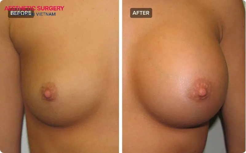 Patient images showing the results before and after undergoing tubular breast augmentation.