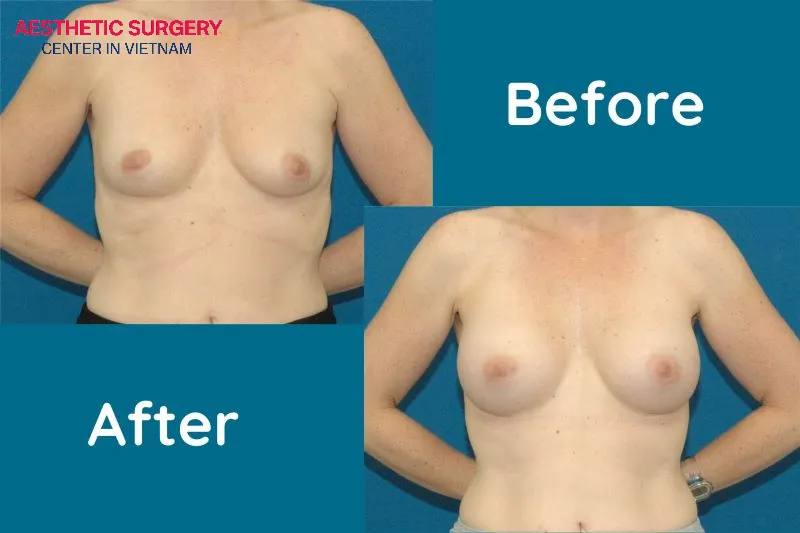 After undergoing tubular breast augmentation, the patient’s breasts show significant improvement compared to their previous shape.