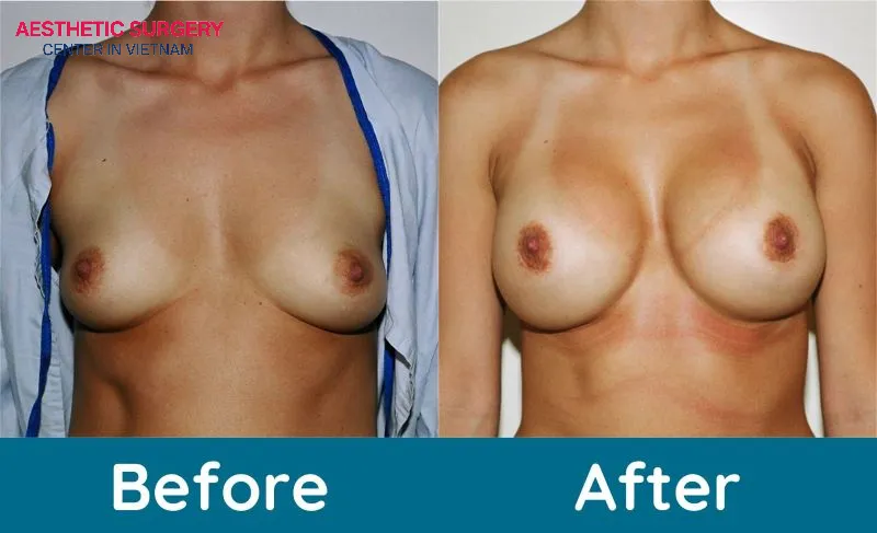 Choosing a reputable clinic ensures that the results of your breast shape meet your expectations.
