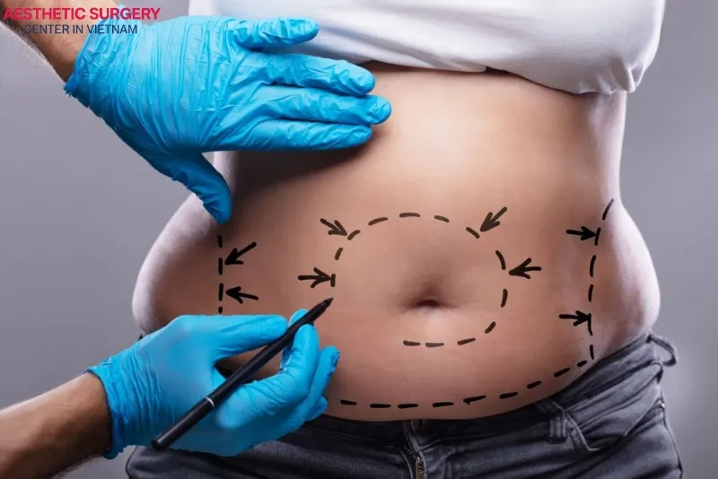 A tummy tuck removes excess skin and fat from the abdominal area while tightening the abdominal muscles for a firmer, more toned stomach.