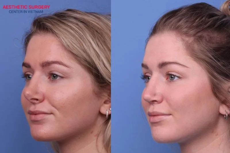 This method is suitable for individuals seeking a subtle nose lift who prefer to avoid invasive surgery on the nasal structure.