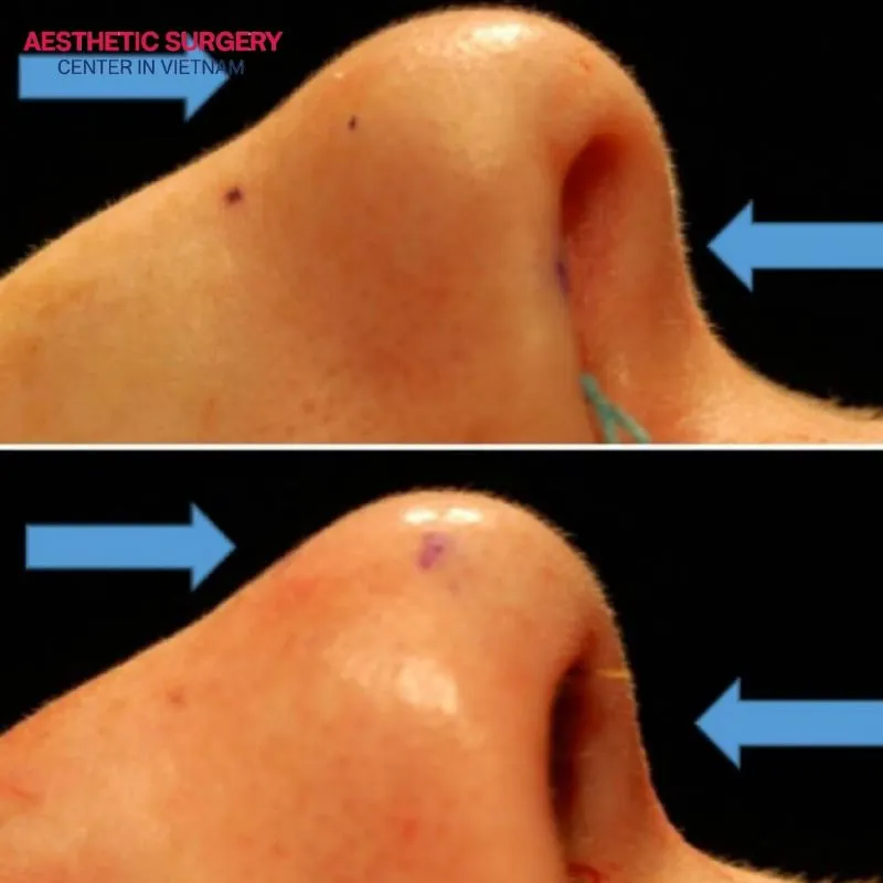 Closed rhinoplasty is performed by the surgeon through incisions inside the nose, avoiding any impact on the external skin.