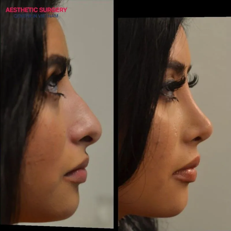 Suitable for individuals with minimal nasal imperfections who only need minor bridge adjustments.