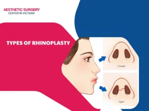 Types of rhinoplasty