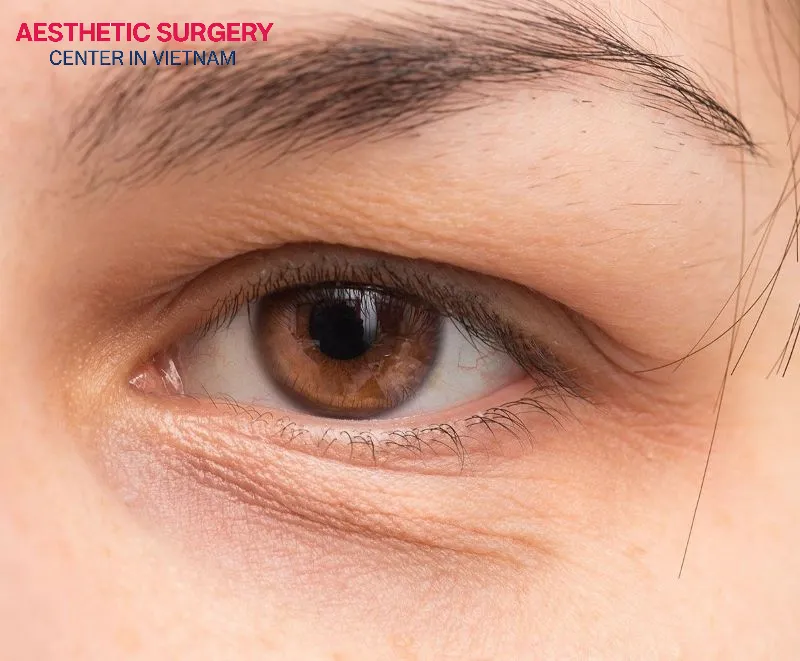 Excess fat in the upper eyelids that accumulates over time can droop, making the face look tired and fatigued.