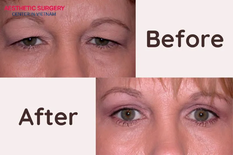 This method not only brings brighter, more defined eyes but also helps facial expressions appear more natural.