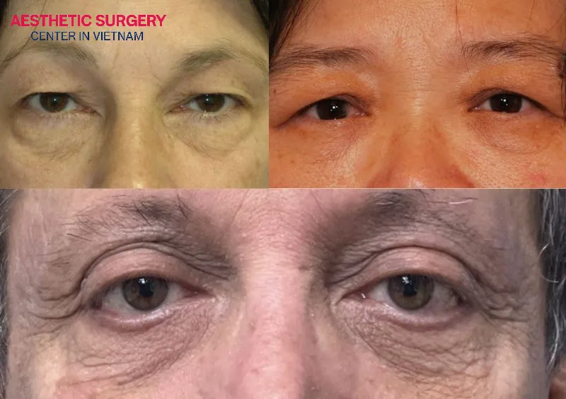 Some middle-aged individuals or those with naturally thick upper eyelid fat can also undergo this procedure.
